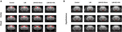 Alternation of Resting-State Functional Connectivity Between Visual Cortex and Hypothalamus in Guinea Pigs With Experimental Glucocorticoid Enhanced Myopia After the Treatment of Electroacupuncture